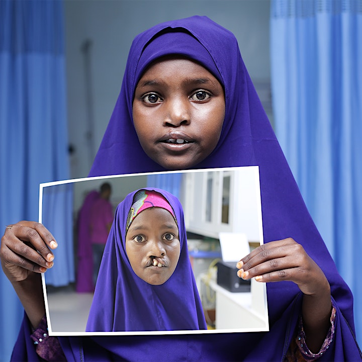 young female smiling while she holds photo of herself before cleft surgery