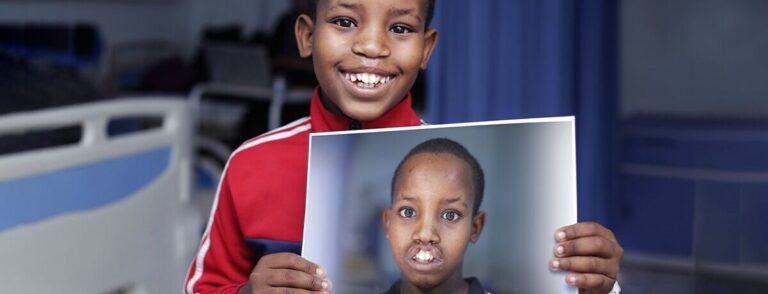 young boy holding before photo of cleft lip and now smiling in red jacket post-surgery